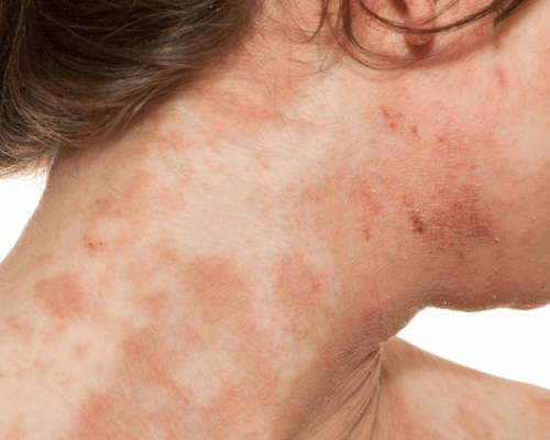 Eczema Atópico - All 2 Skin