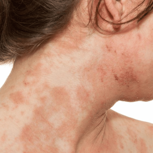 Eczema Atópico - All 2 Skin